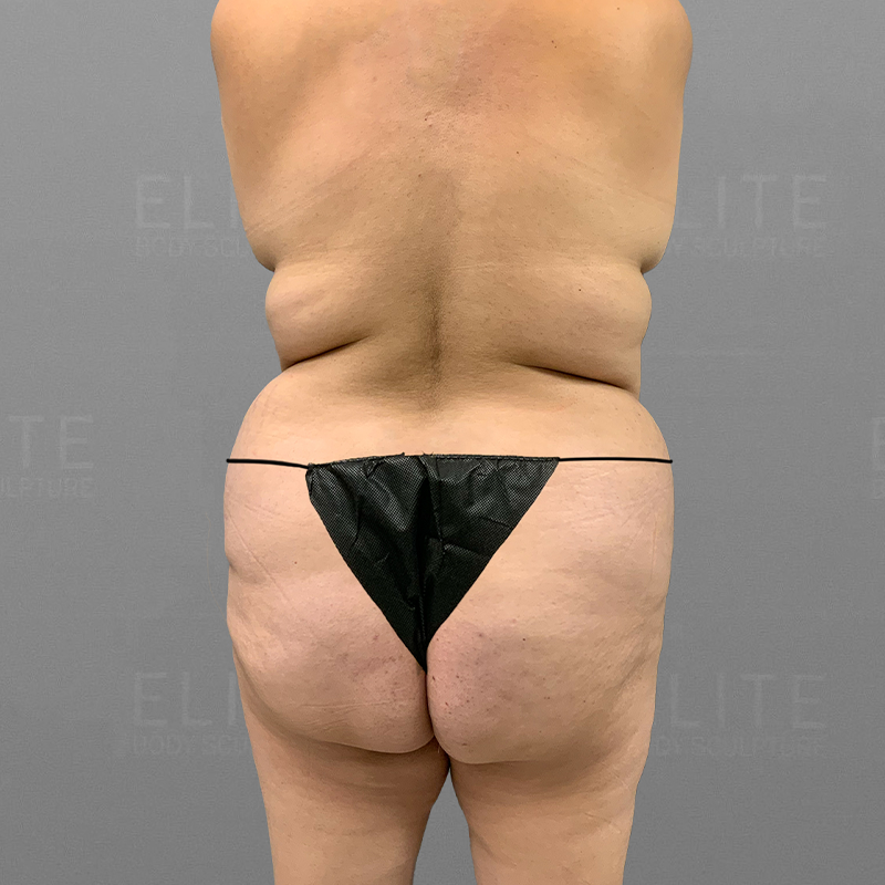 back airsculpt before