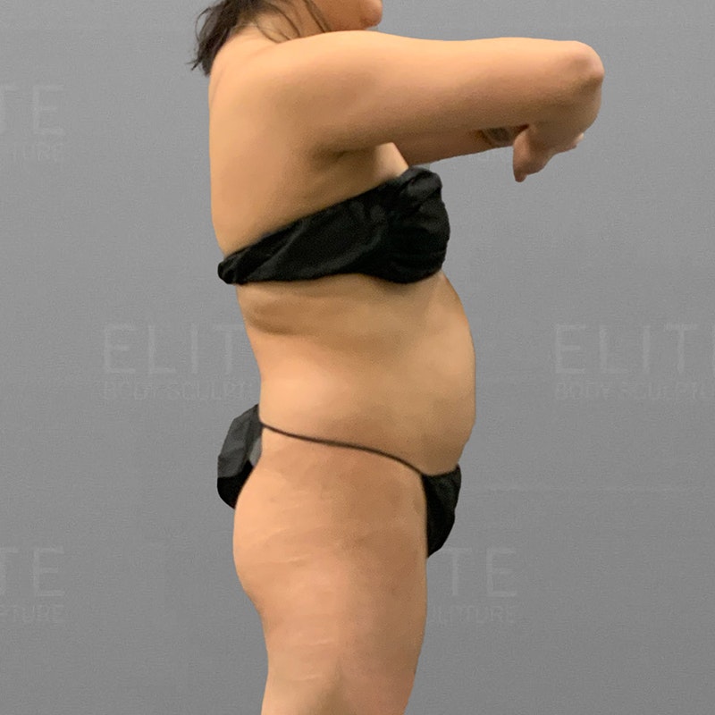 back and full ab airsculpt before