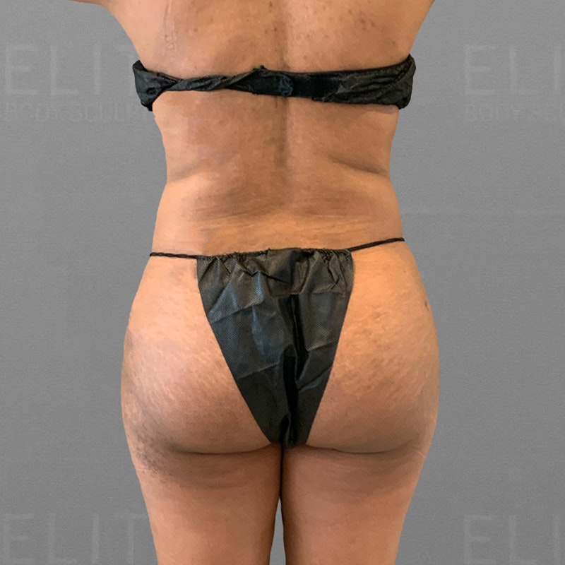 After AirSculpt HipFlip