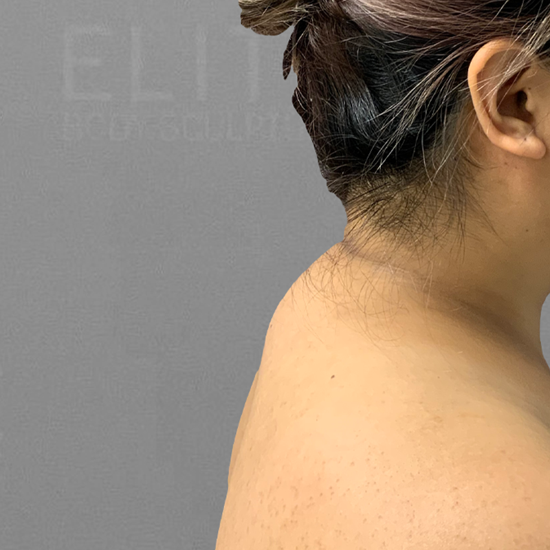 Before buffalo hump airsculpt