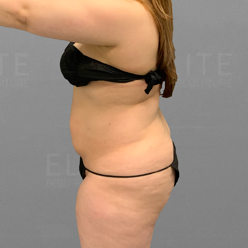 lower back lipo before