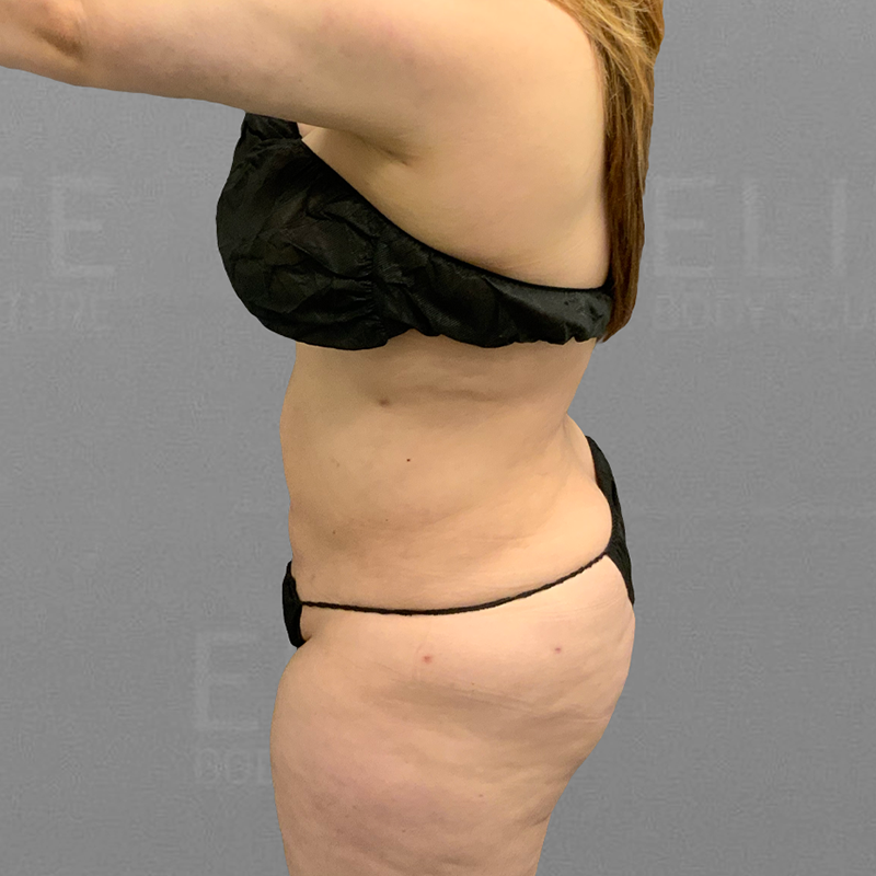 lower back lipo after