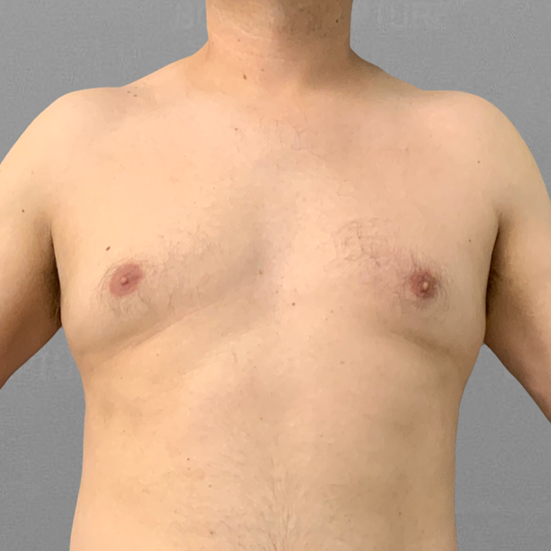 Before AirSculpt male chest reduction