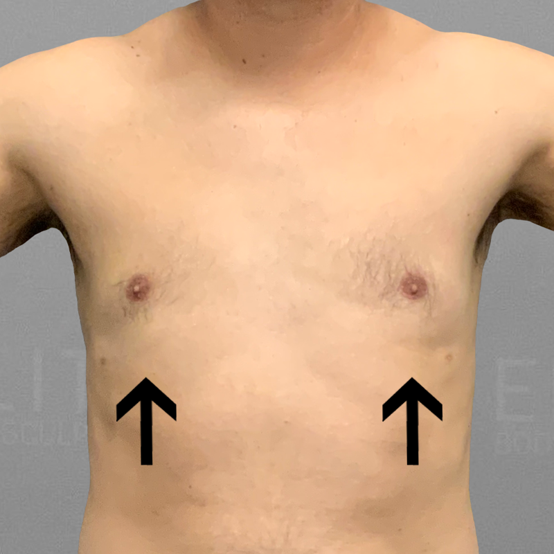After AirSculpt male chest reduction