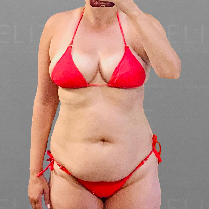 before full ab airsculpt