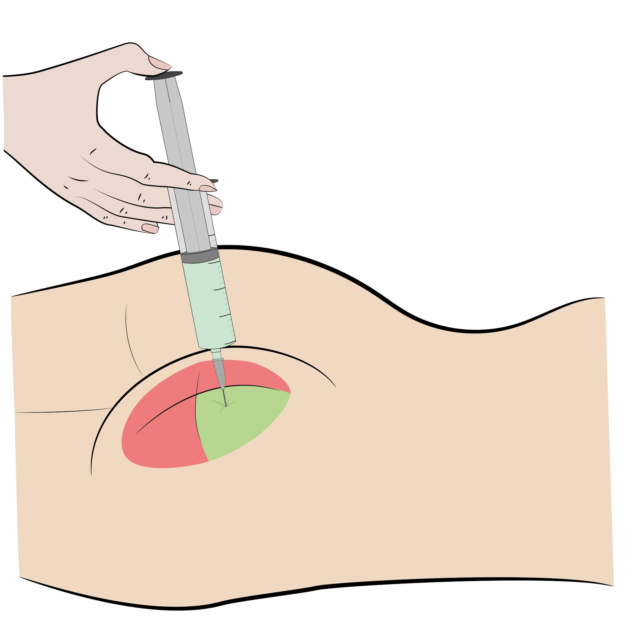 illustrations of fat injection in buttocks