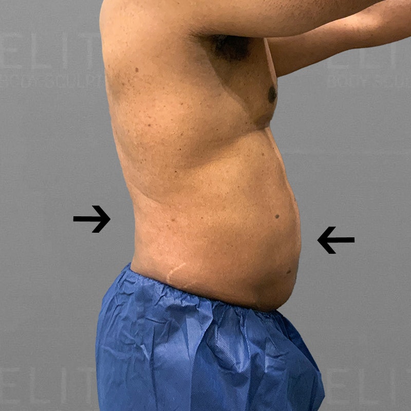 After male stomach airsculpt
