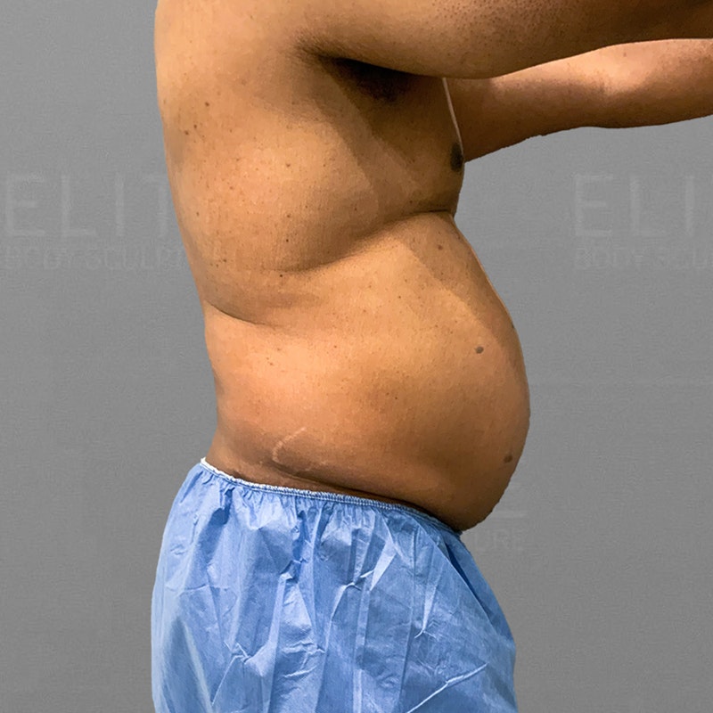 before male stomach airsculpt