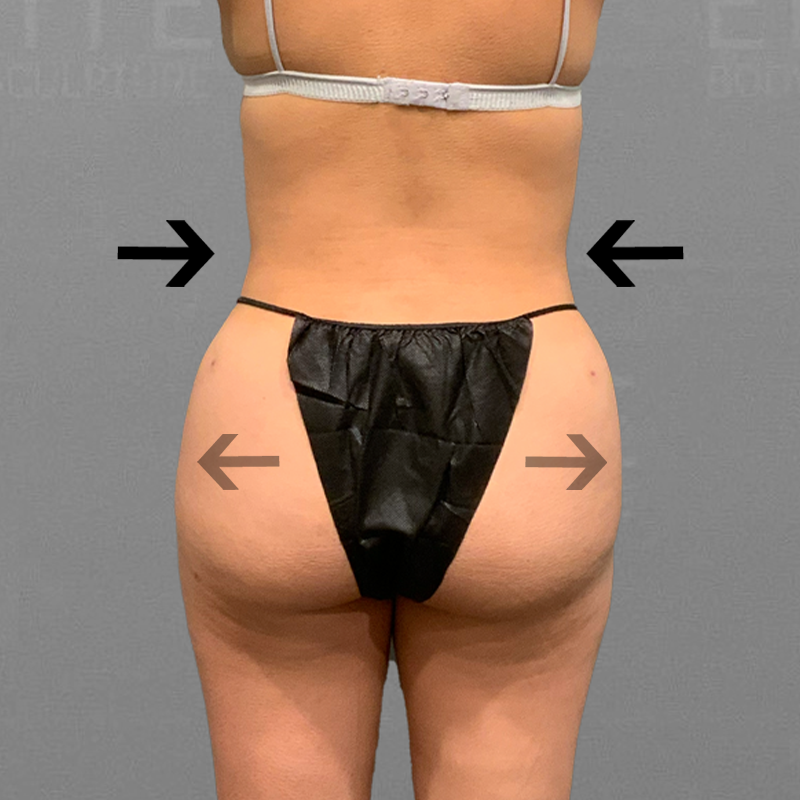 After hip augmentation airsculpt