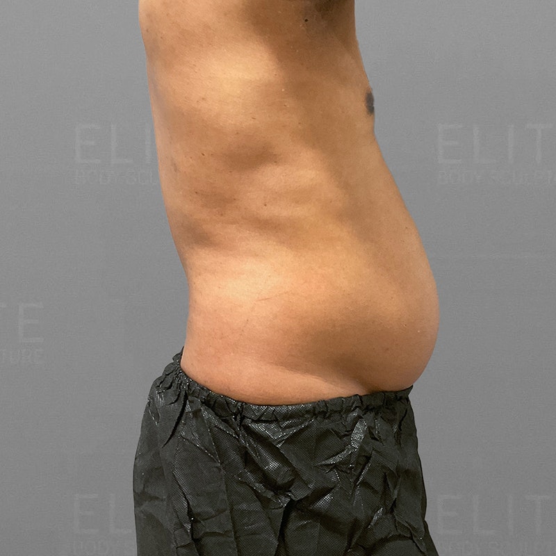 before 48 hour six pack lipo