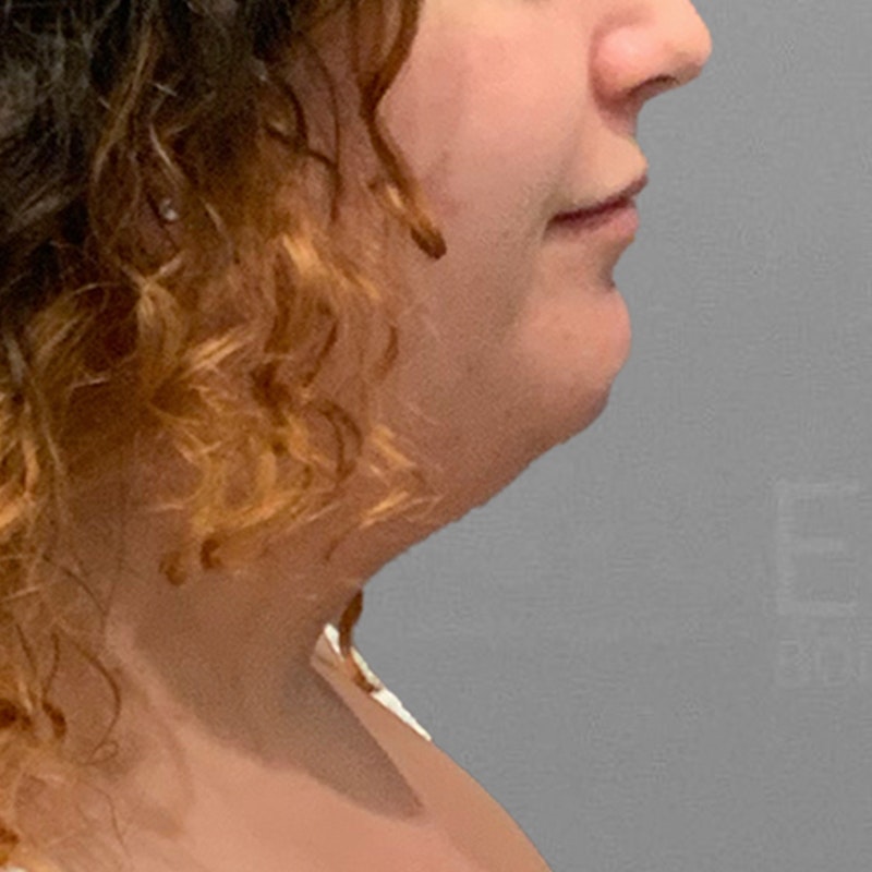 before chin liposuction