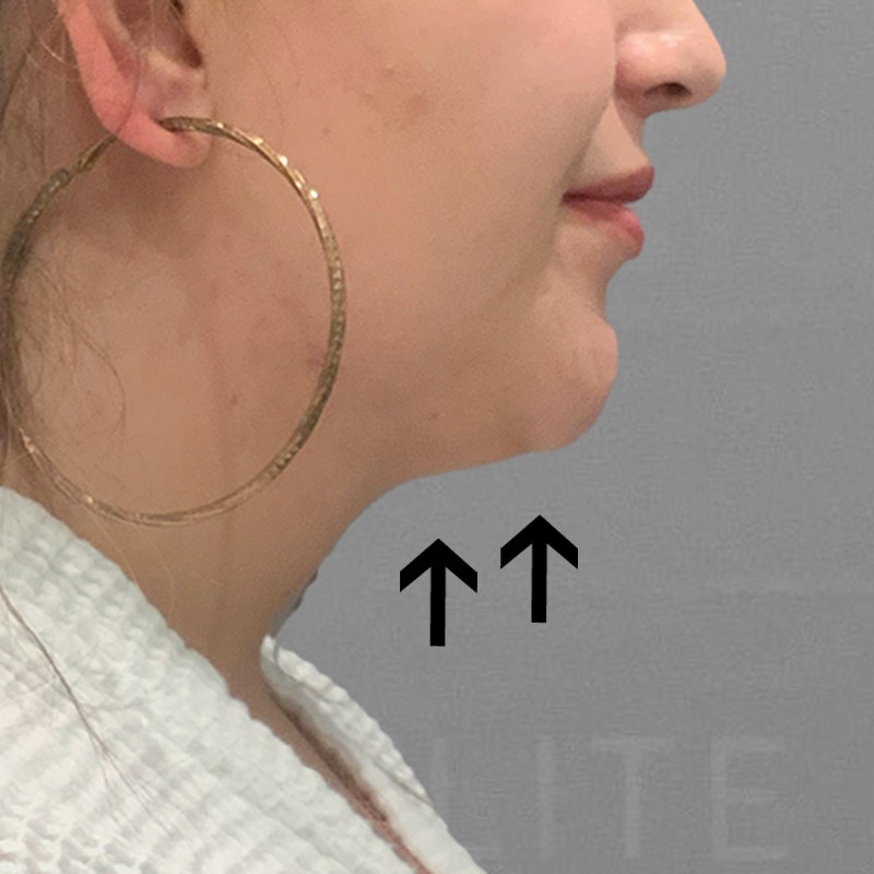 after chin liposuction