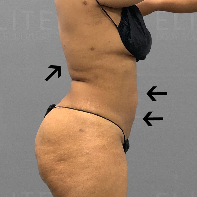 Stomach AirSculpt after