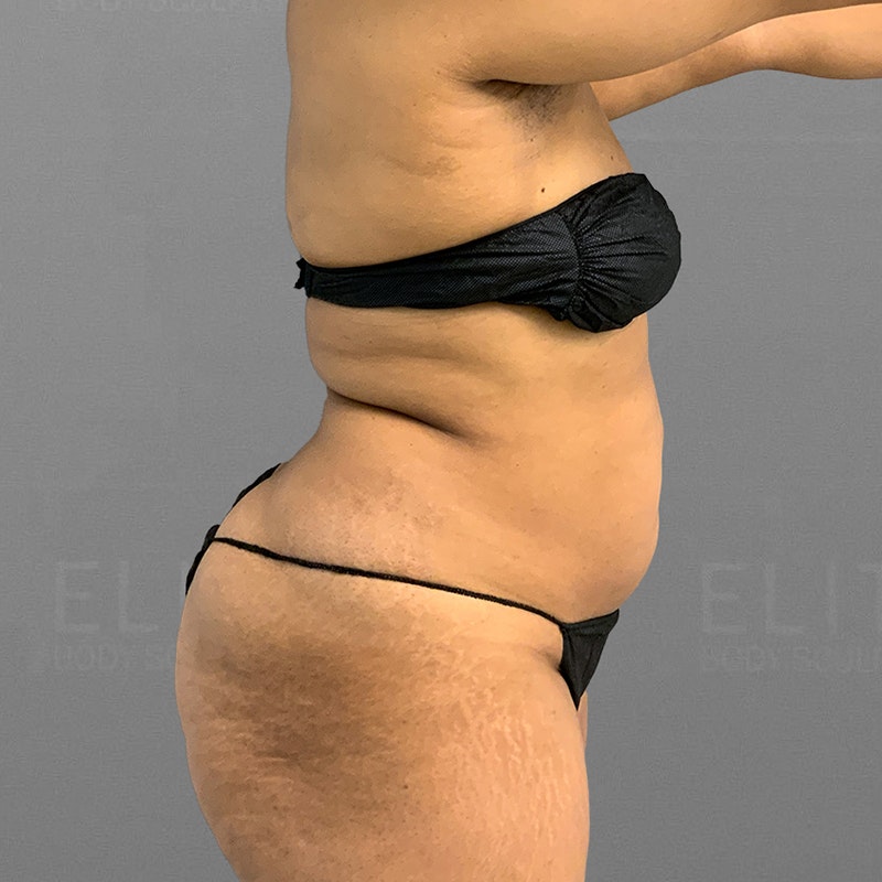 stomach airsculpt before