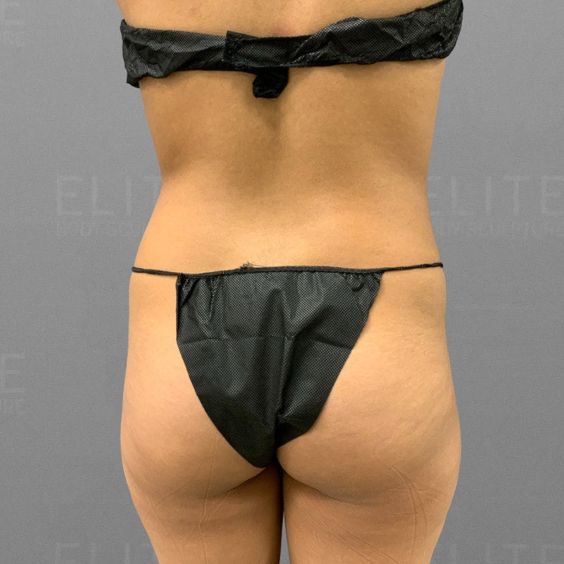 before back and bbl airsculpt