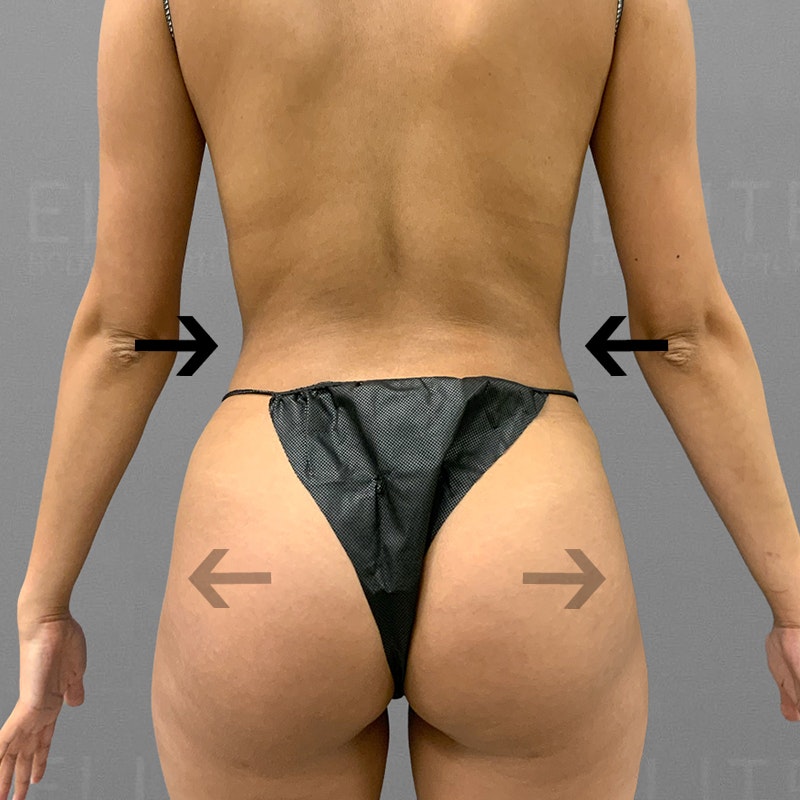 after back and bbl airsculpt