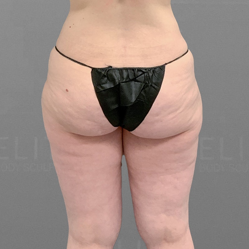 before leg airsculpt
