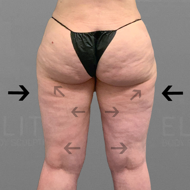 Can Liposuction Treat the Banana Roll Area?