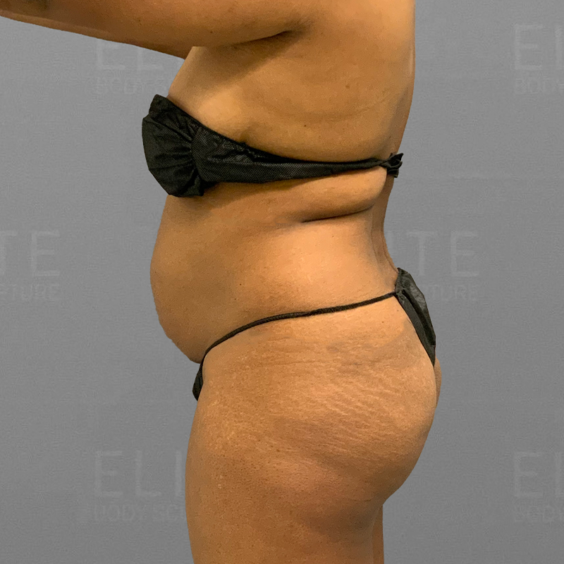before back bra roll airsculpt