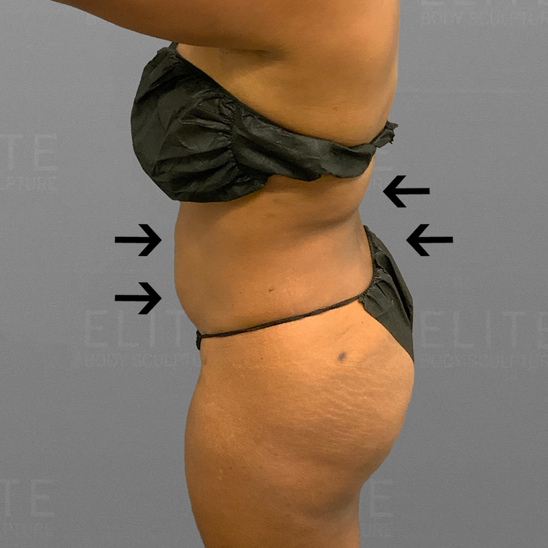After back bra roll airsculpt