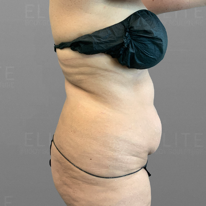 before full ab and back lipo