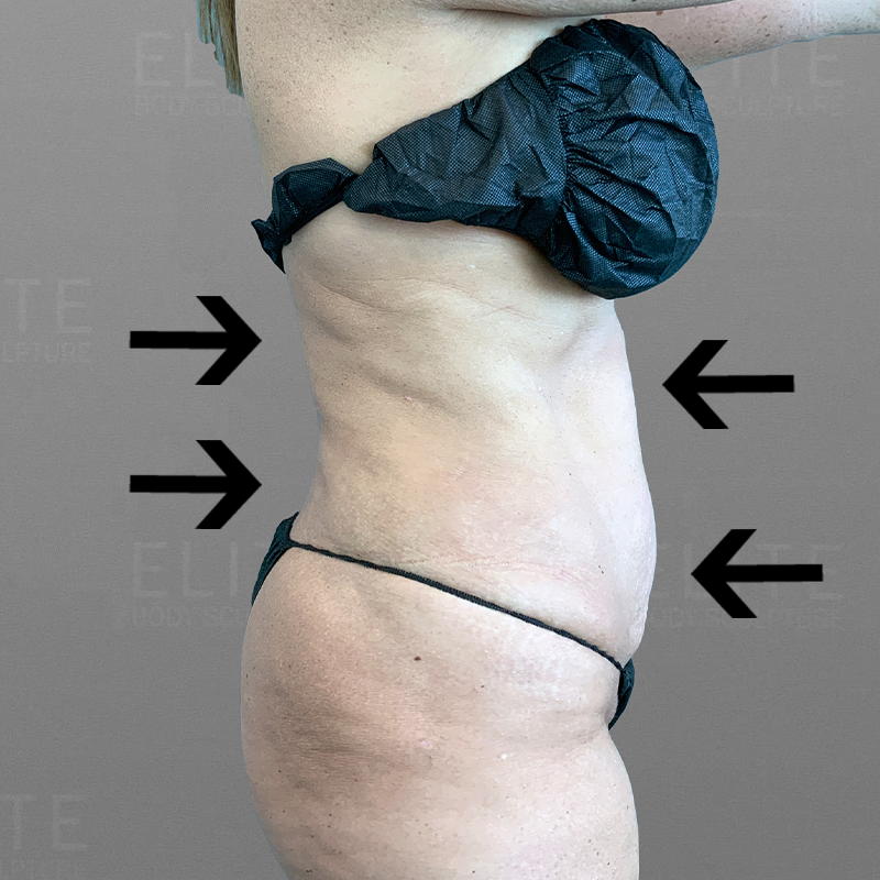 after full ab and back lipo