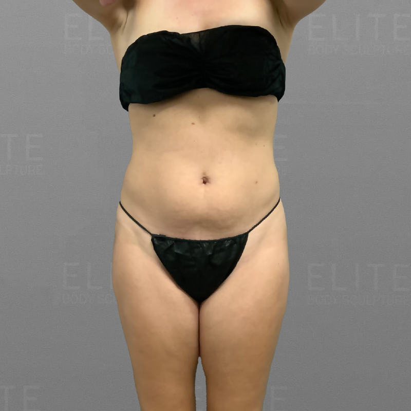 Full ab before