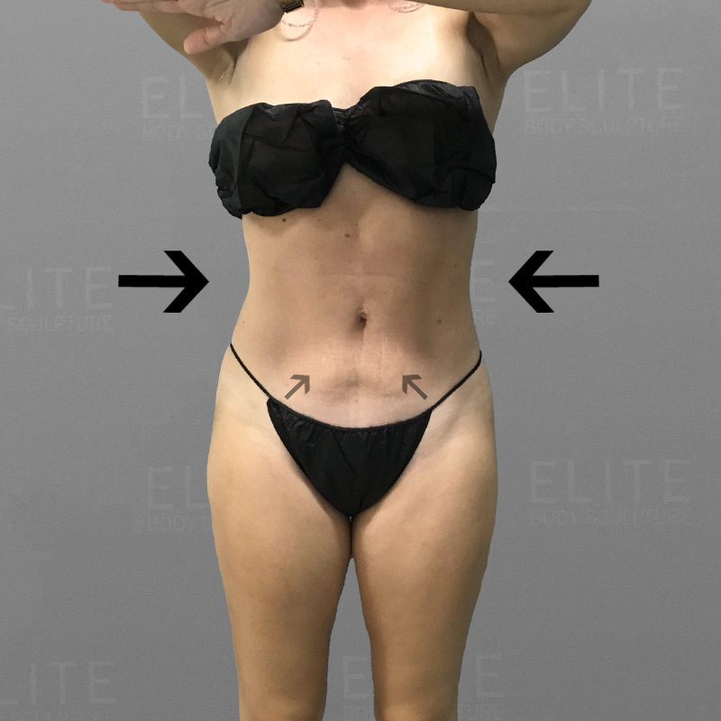 Full ab after