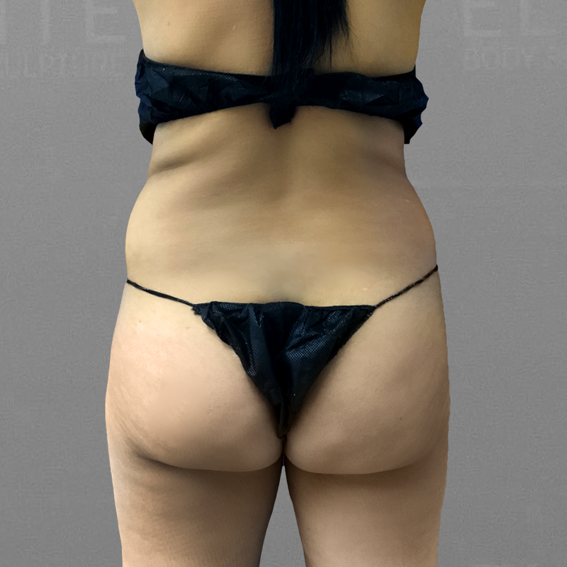 bbl and ab before