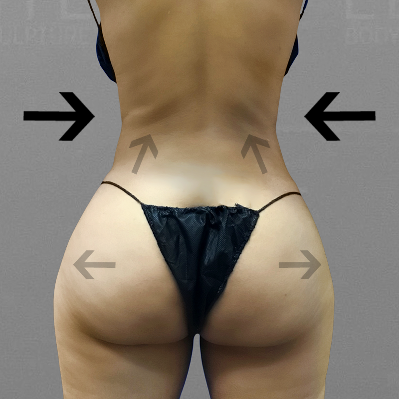 bbl and ab after