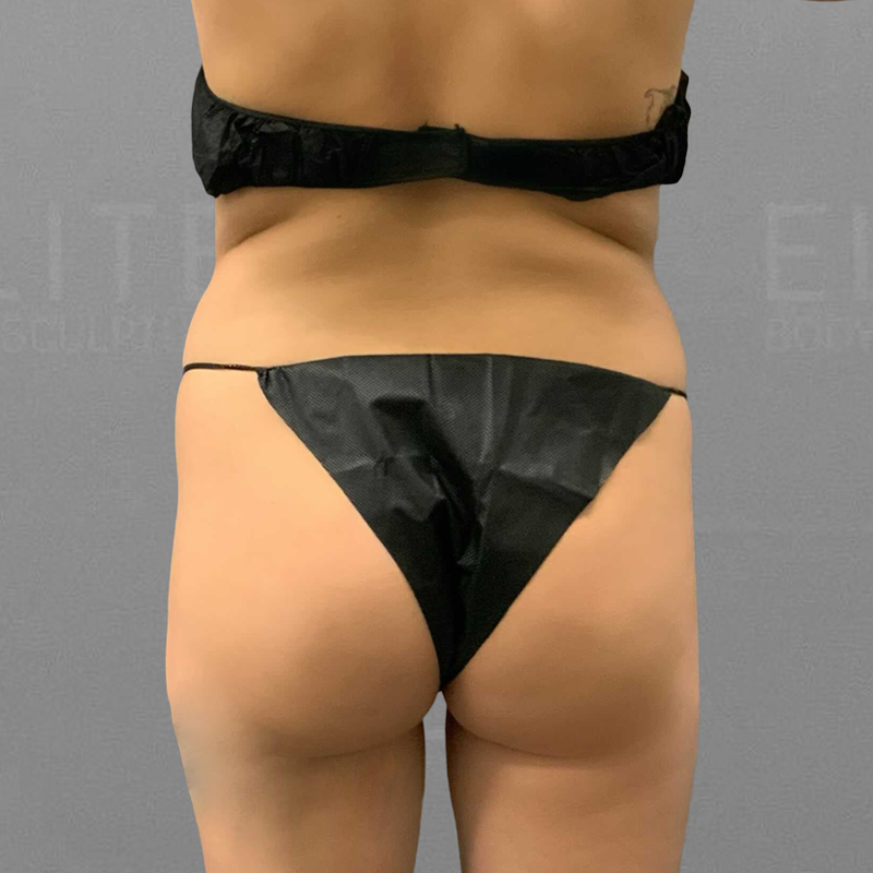 Before airsculpt bbl