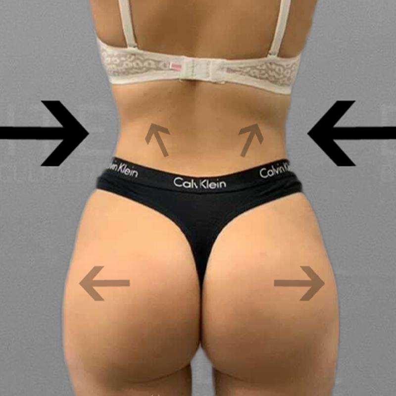 after airsculpt bbl