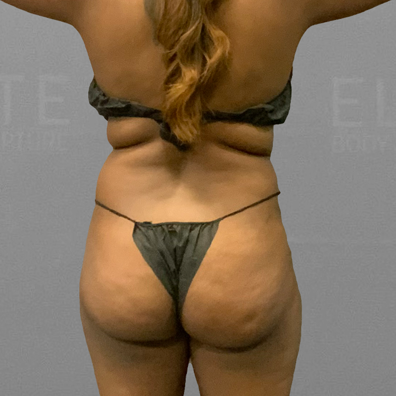 before hip flip photo