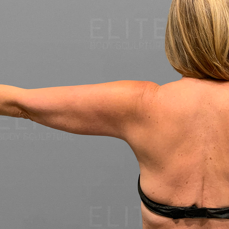 before arm liposuction airsculpt 