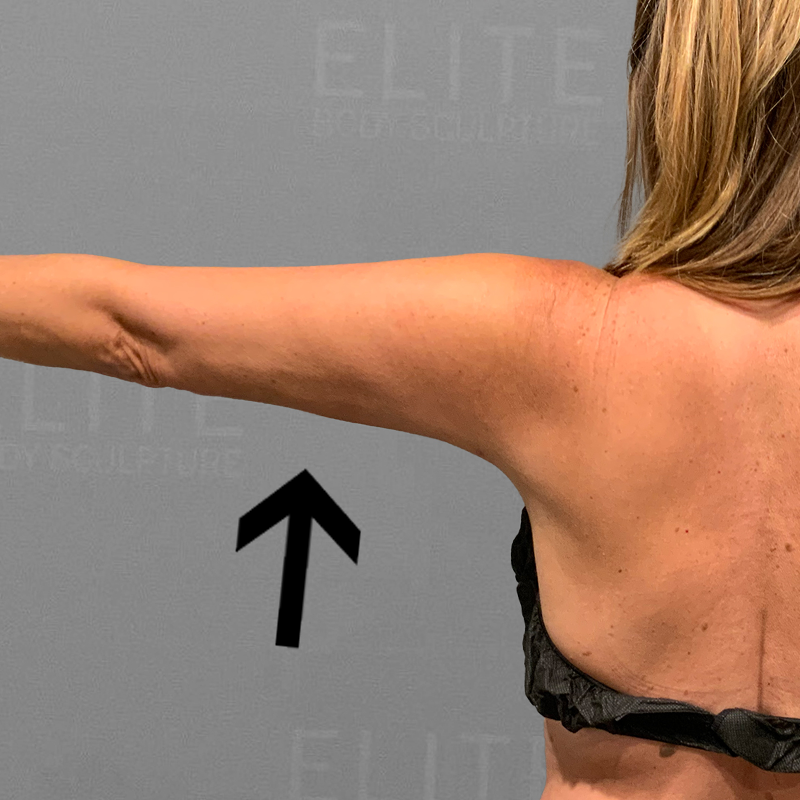 after arm liposuction airsculpt