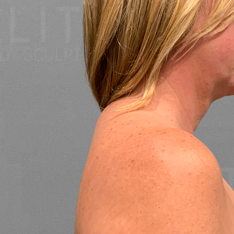 before buffalo hump liposuction