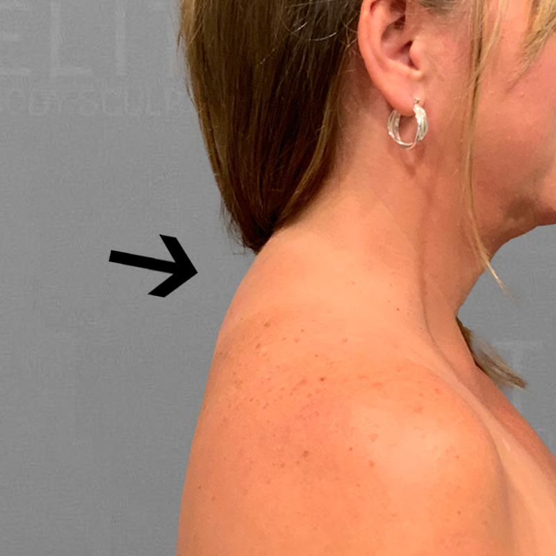 after buffalo hump liposuction