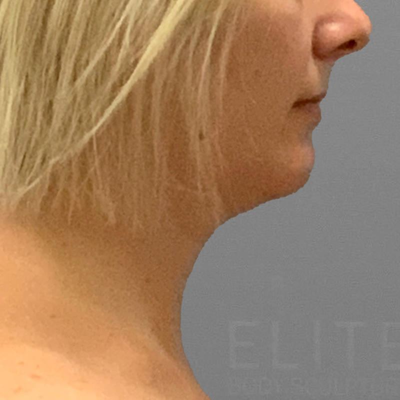after chin lipo