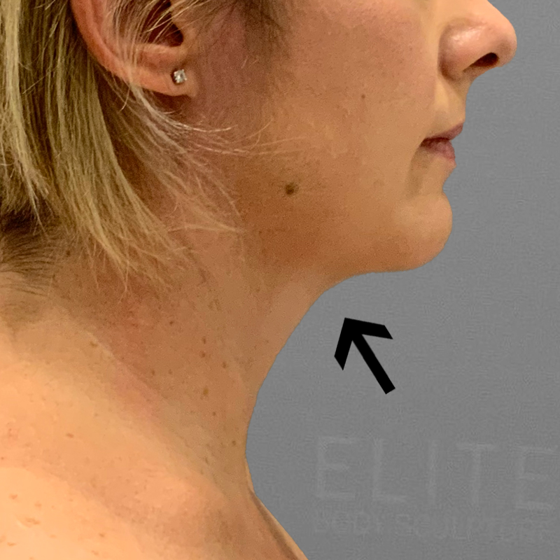 after chin airsculpt