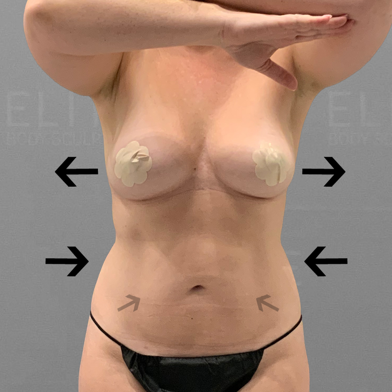after full abdominal airsculpt