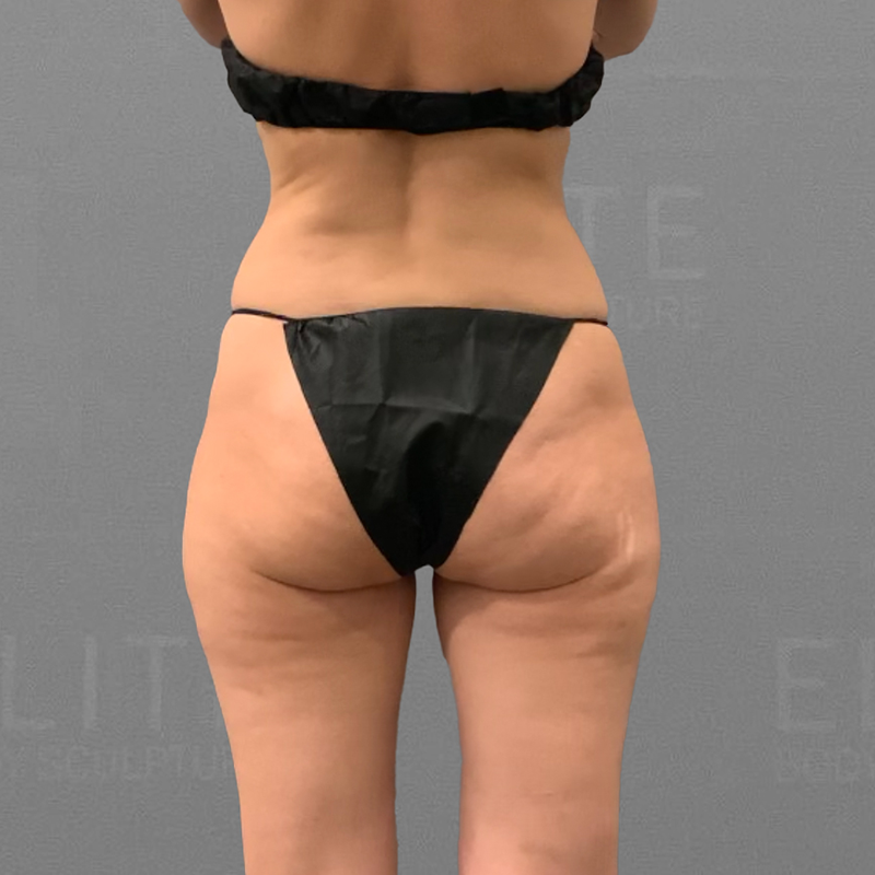 before thigh airsculpt