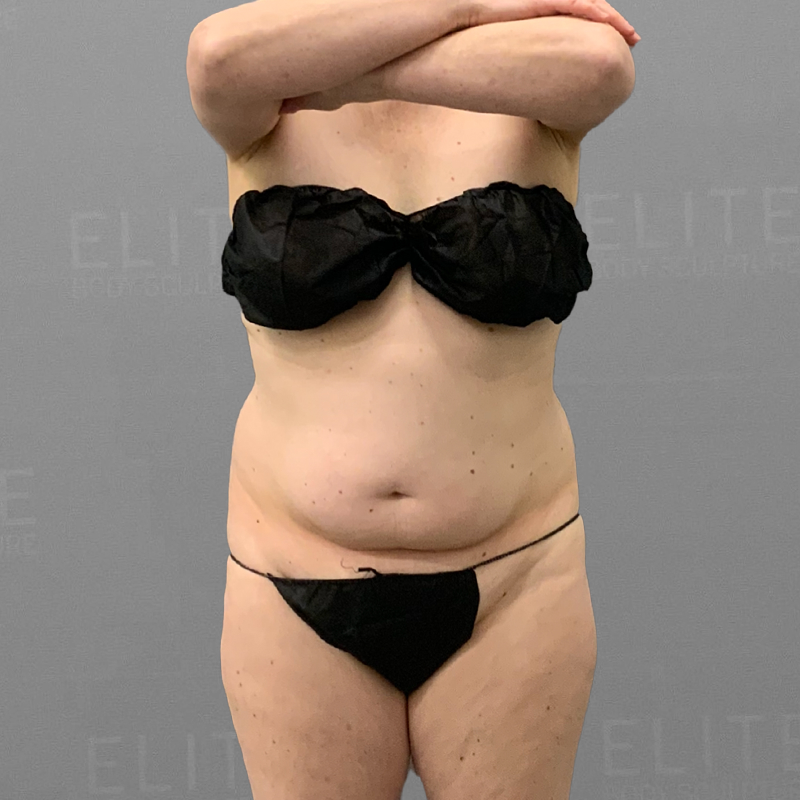 before full abdominal airsculpt