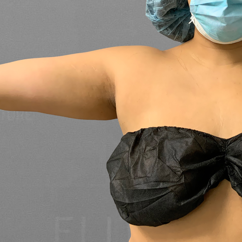 before underarm liposuction