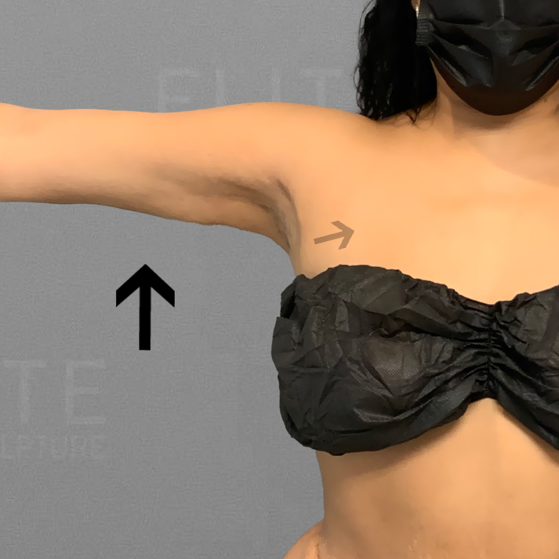 after underarm liposuction
