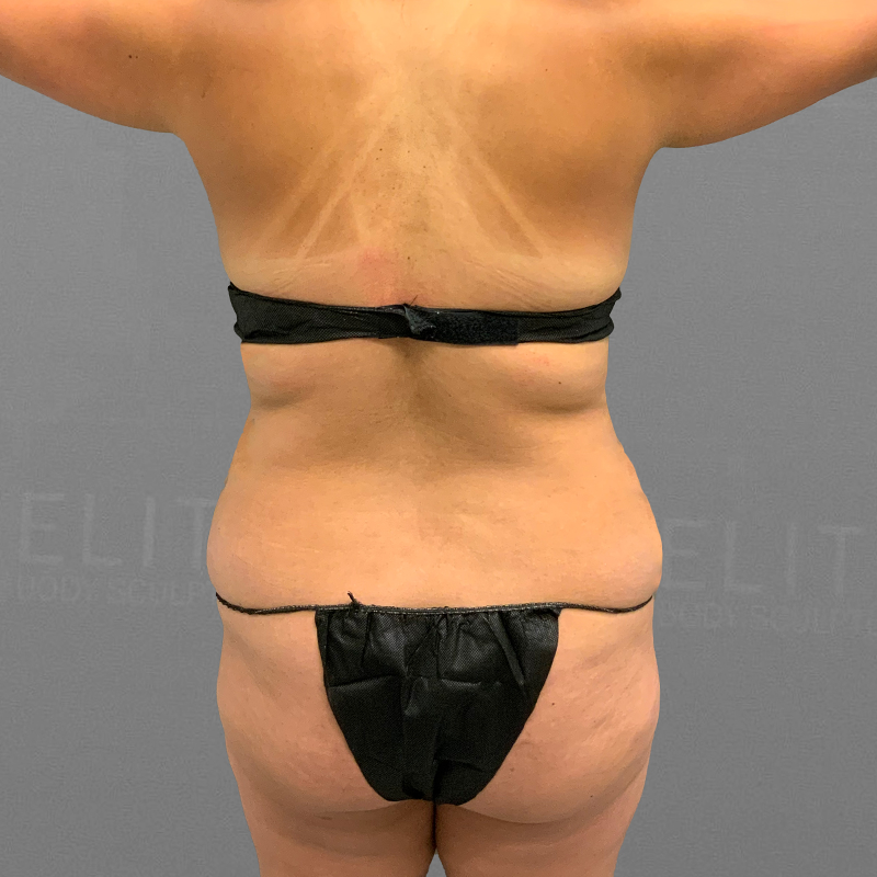 before back airsculpt