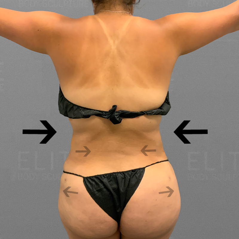 after back airsculpt