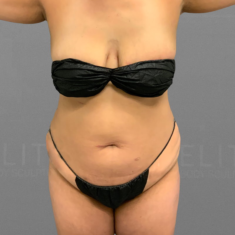 before full ab and bbl airsculpt