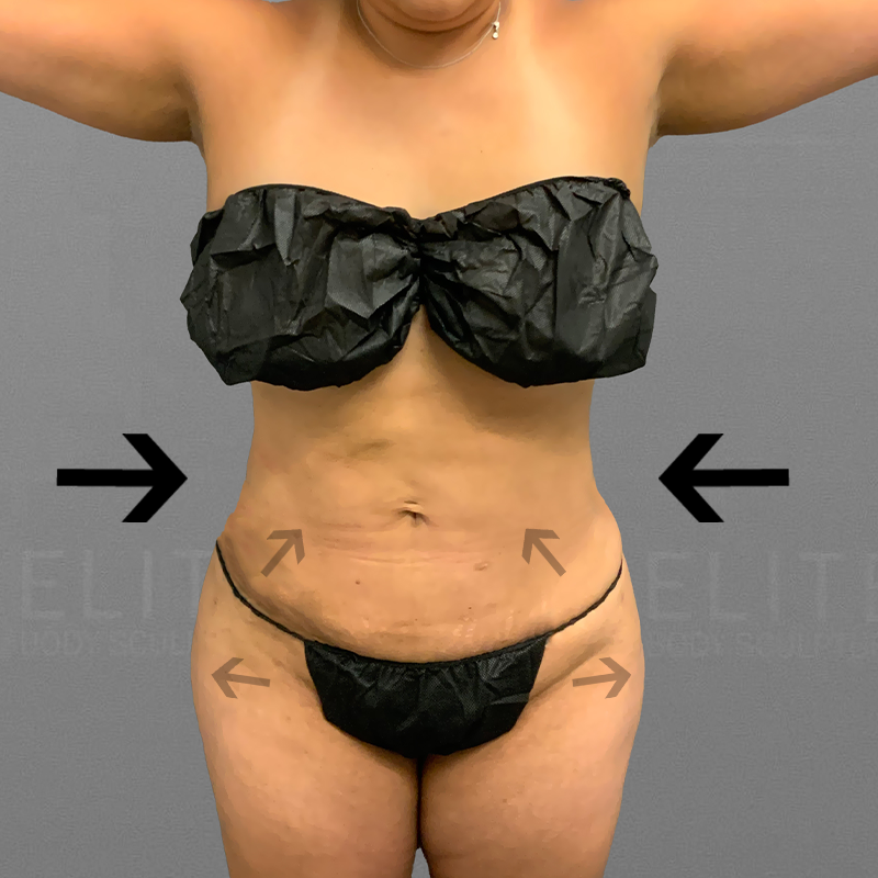 after full ab and bbl airsculpt