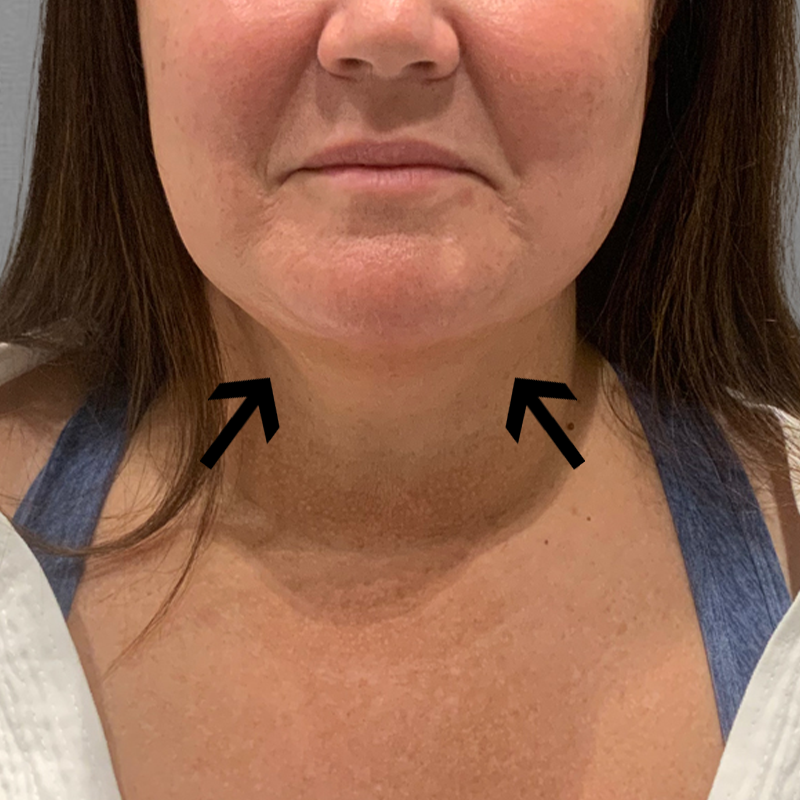 after submental airsculpt