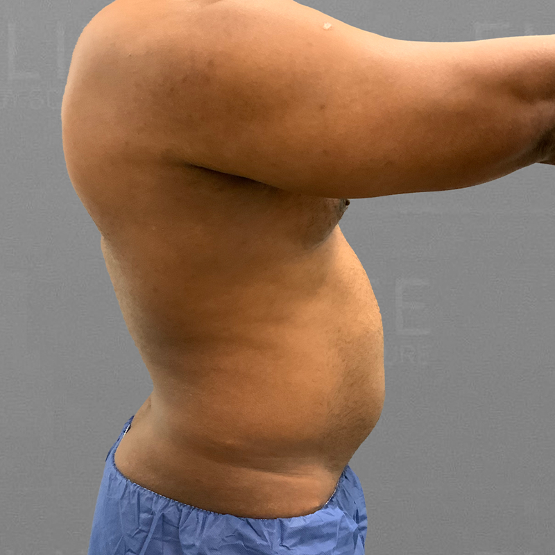 before 48 hour six pack airsculpt